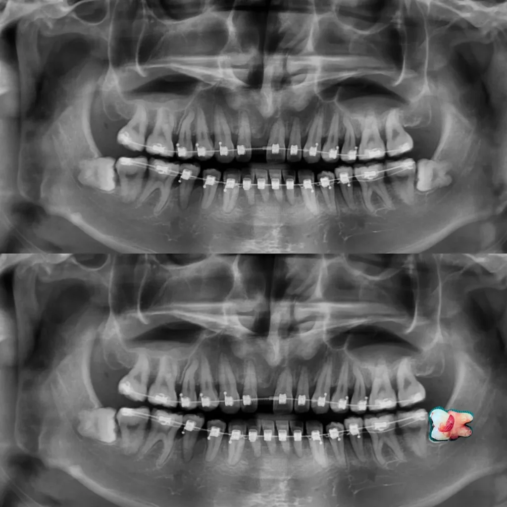 Wisdom Tooth (Third Molar) Should You Remove It or Keep It