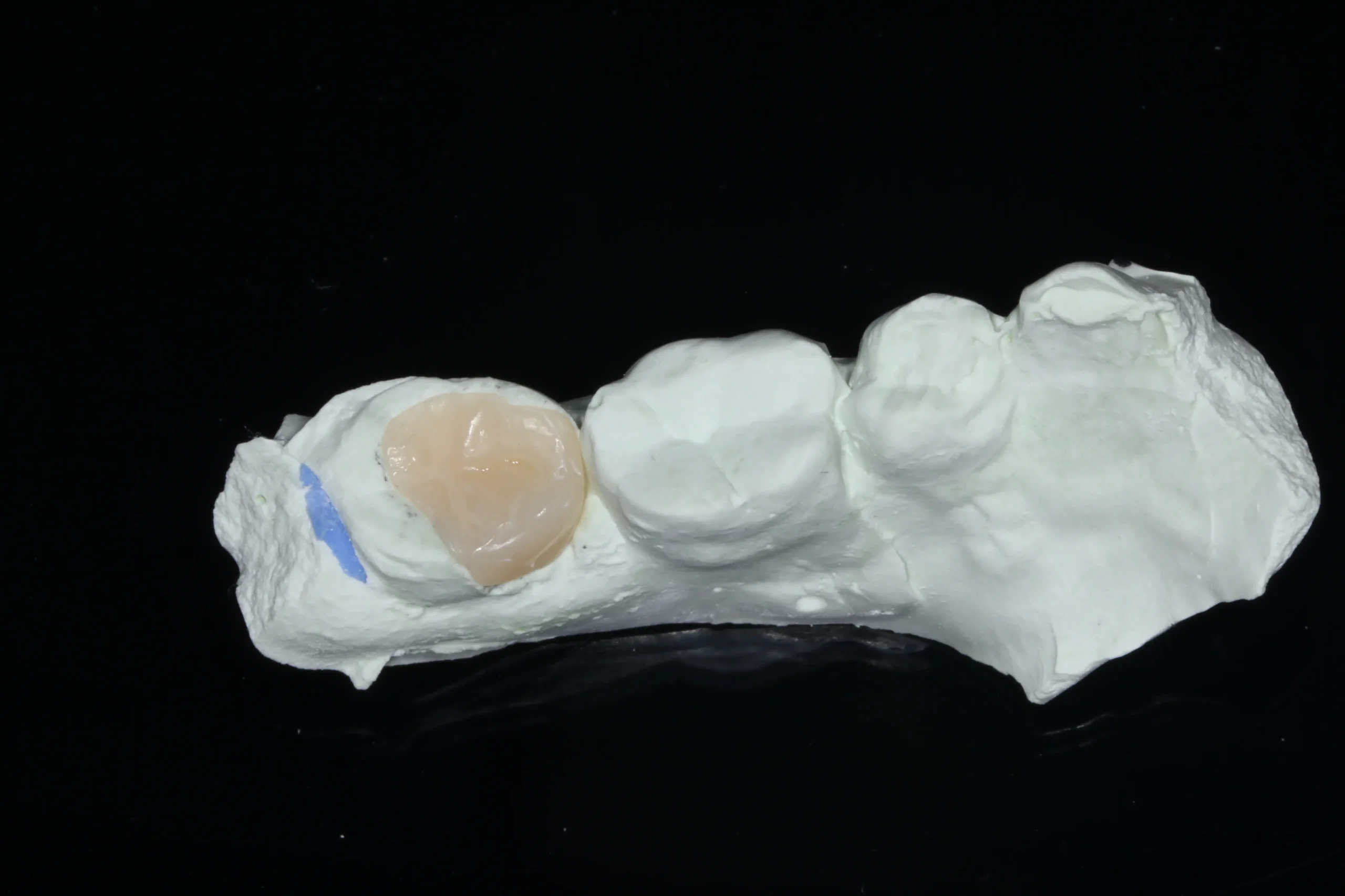 Biomimetic Dentistry vs Conventional Restorative Dentistry