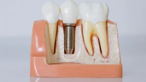 How to Decide Between Cement-Retained and Screw-Retained Dental Implants