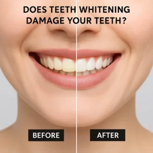 Before and after teeth whitening comparison