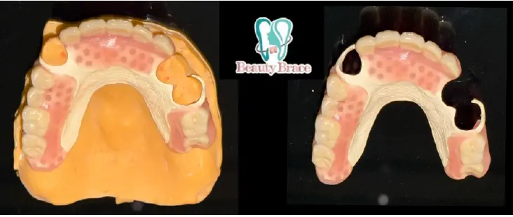 PEEK denture frameworks